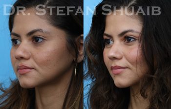 patient before and after asian rhinoplasty
