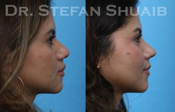 patient before and after asian rhinoplasty
