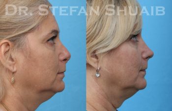 patient before and after revision rhinoplasty