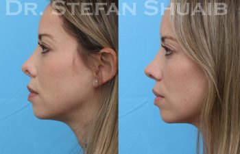 patient before and after revision rhinoplasty