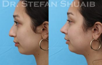 patient before and after rhinoplasty