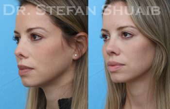 patient before and after revision rhinoplasty