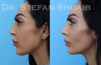 patient before and after rhinoplasty