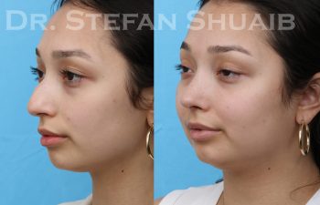 patient before and after rhinoplasty