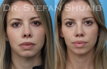 patient before and after revision rhinoplasty