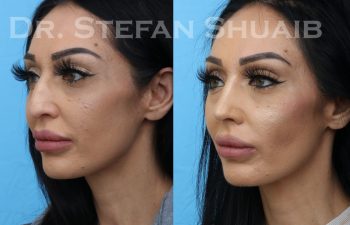 patient before and after rhinoplasty