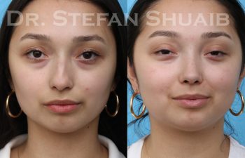 patient before and after rhinoplasty