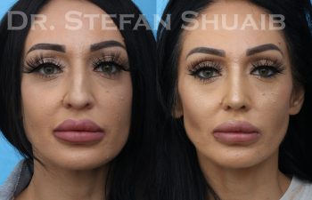 patient before and after rhinoplasty