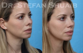 patient before and after revision rhinoplasty