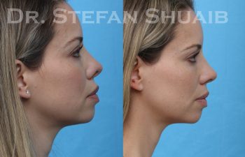 patient before and after revision rhinoplasty