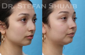 patient before and after rhinoplasty