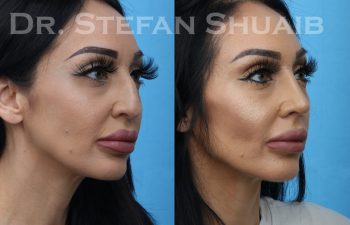 patient before and after rhinoplasty