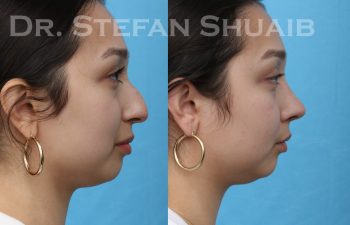 patient before and after rhinoplasty