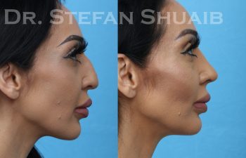 patient before and after rhinoplasty