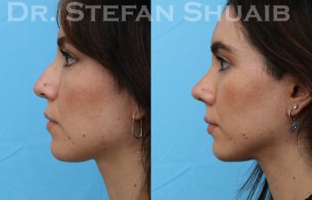 patient before and after rhinoplasty