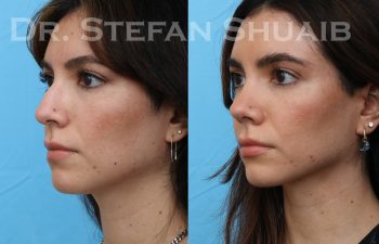 patient before and after rhinoplasty