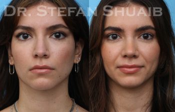 patient before and after rhinoplasty