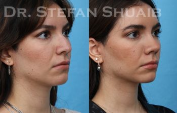 patient before and after rhinoplasty