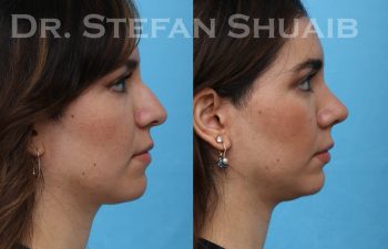 patient before and after rhinoplasty