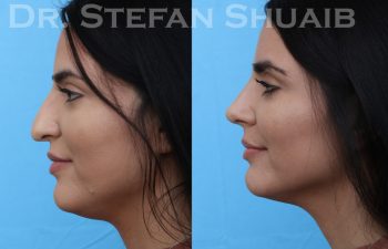 patient before and after rhinoplasty