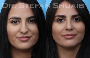 patient before and after rhinoplasty