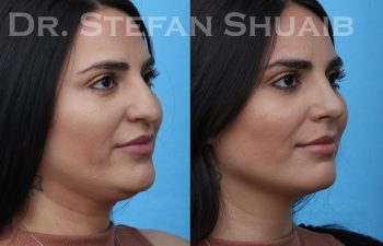 patient before and after rhinoplasty