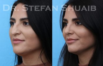 patient before and after rhinoplasty