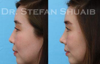 patient before and after rhinoplasty