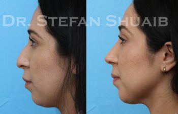 patient before and after rhinoplasty