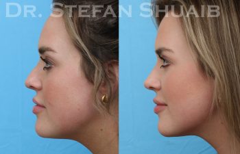 patient before and after rhinoplasty