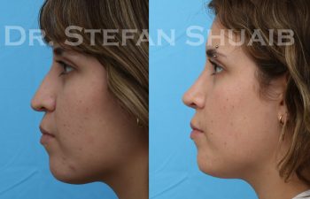 patient before and after rhinoplasty