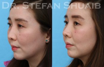 patient before and after rhinoplasty