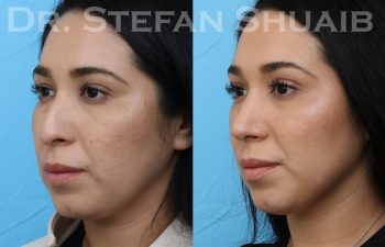 patient before and after rhinoplasty