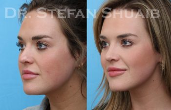 patient before and after rhinoplasty