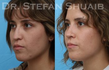 patient before and after rhinoplasty