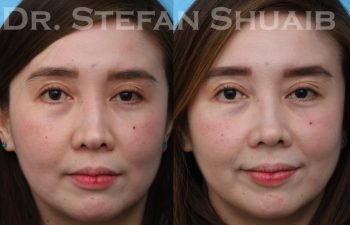 patient before and after rhinoplasty