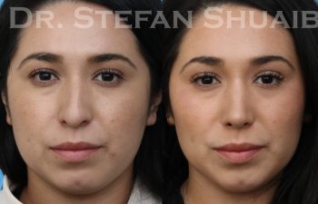 patient before and after rhinoplasty