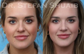 patient before and after rhinoplasty