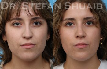 patient before and after rhinoplasty