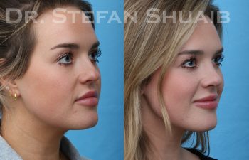 patient before and after rhinoplasty