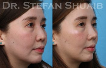 patient before and after rhinoplasty