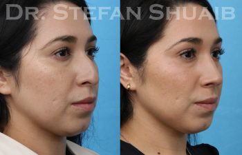 patient before and after rhinoplasty