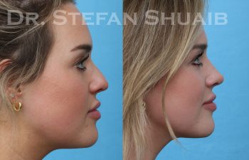 patient before and after rhinoplasty