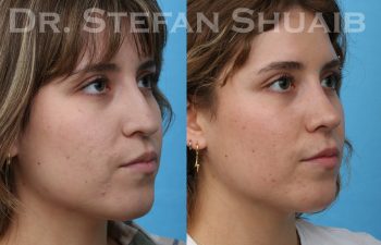 patient before and after rhinoplasty