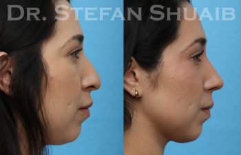 patient before and after rhinoplasty