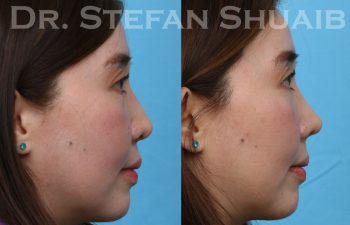 patient before and after rhinoplasty