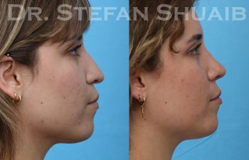 patient before and after rhinoplasty